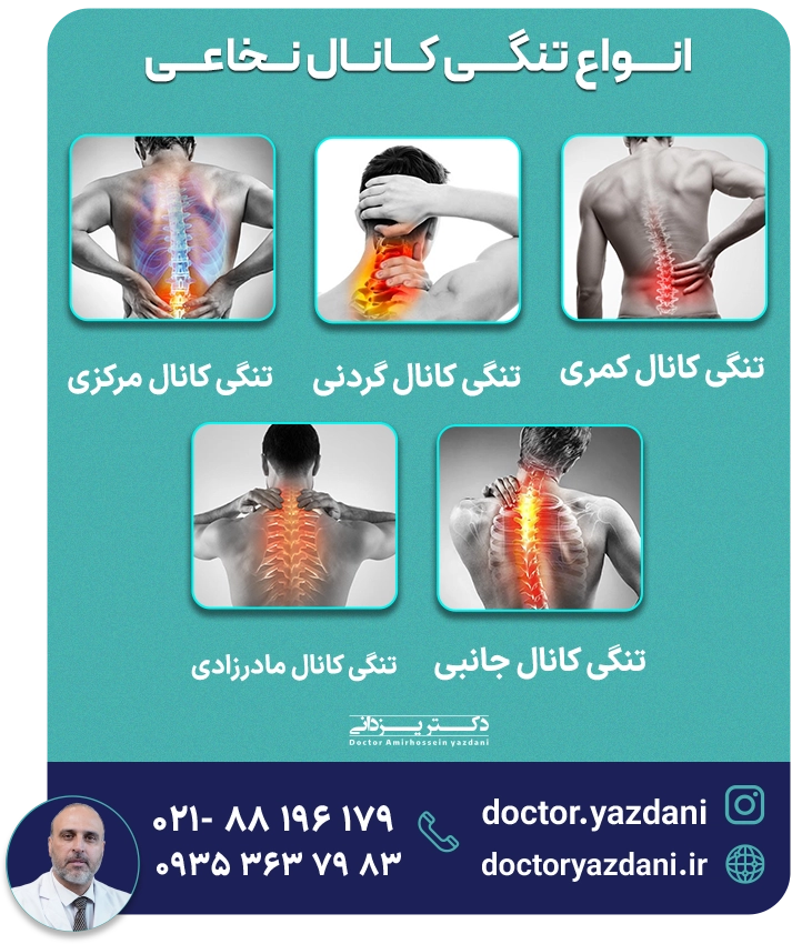 انواع تنگی کانال نخاعی - دکتر یزدانی